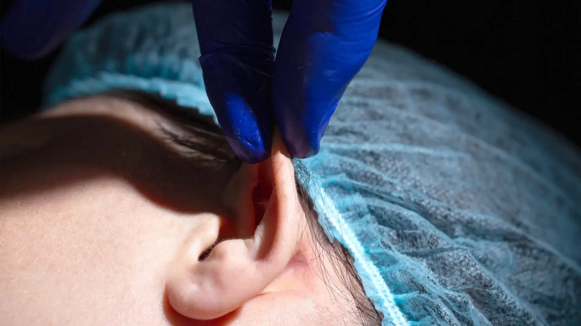 Otoplasty in Turkey antalya Kepçe Kulak Ameliyatı